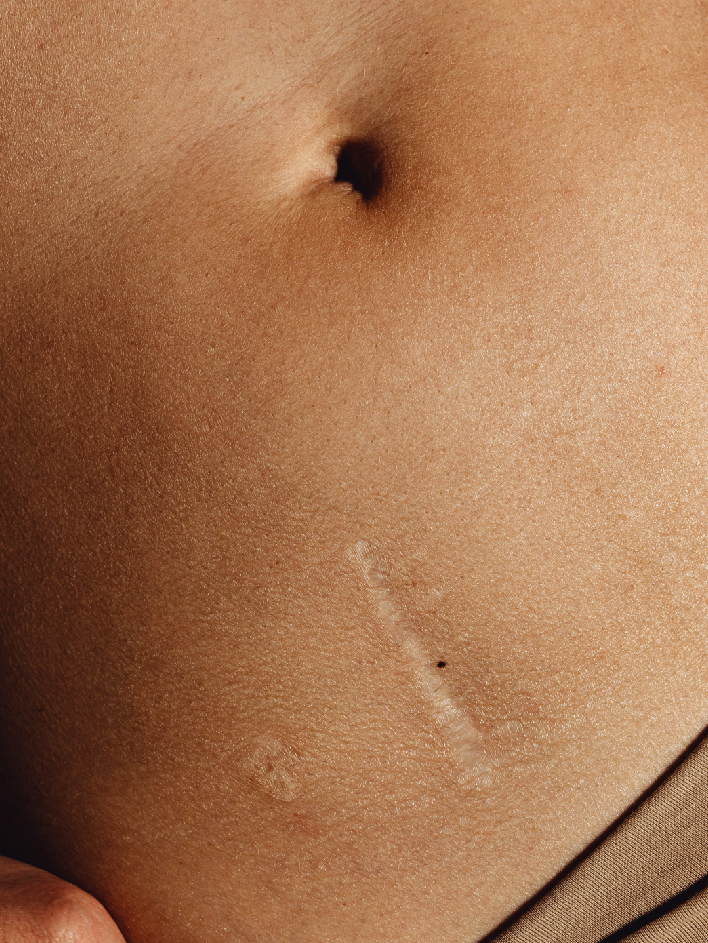 Laser cicatrices au Centre Laser Paris Est