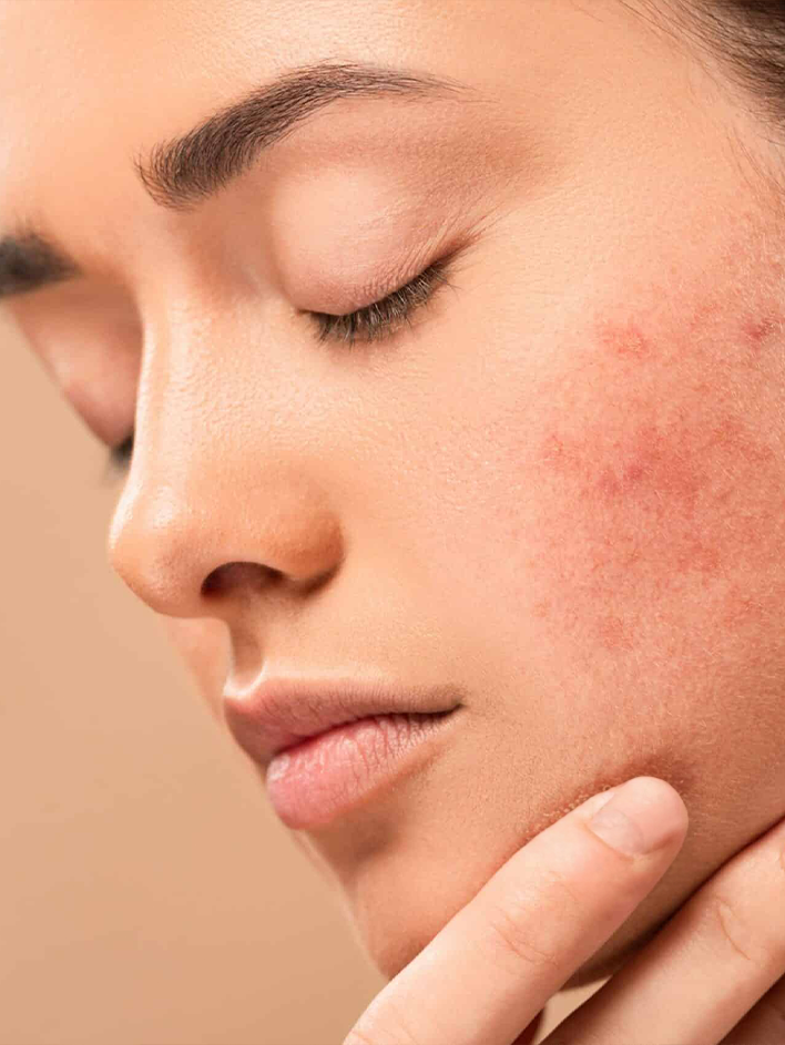 Nos prestations Rougeurs du visage et angiomes au Centre Laser Paris Est