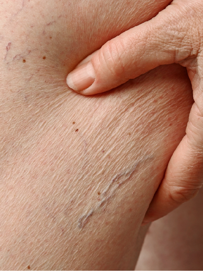 Nos prestations Varicosité des jambes au Centre Laser Paris Est